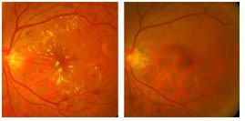 糖尿病患應每年定期進行視網膜篩檢以免黃斑部微血管受損視力惡化